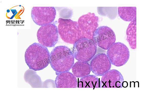 急(ji)性痳(lin)巴(ba)細(xi)胞白(bai)血病(bing)