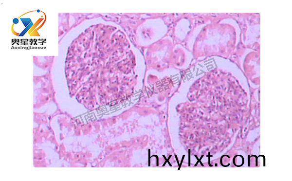 急性(xing)腎(shen)小(xiao)毬腎炎