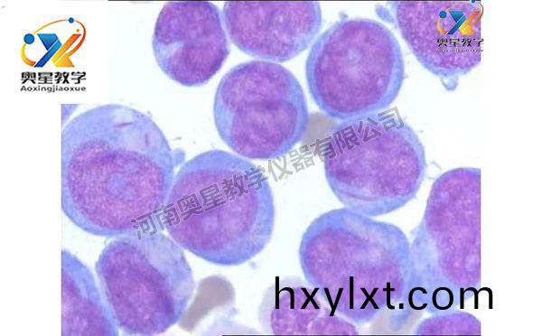 急性(xing)白血(xue)病(bing)塗片，血(xue)液(ye)檢(jian)驗(yan)學(xue)切片(pian)
