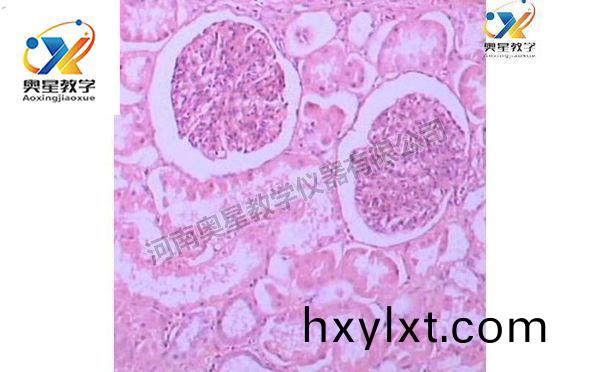 急性腎(shen)小(xiao)毬(qiu)腎炎，病(bing)理學(xue)切片(pian)