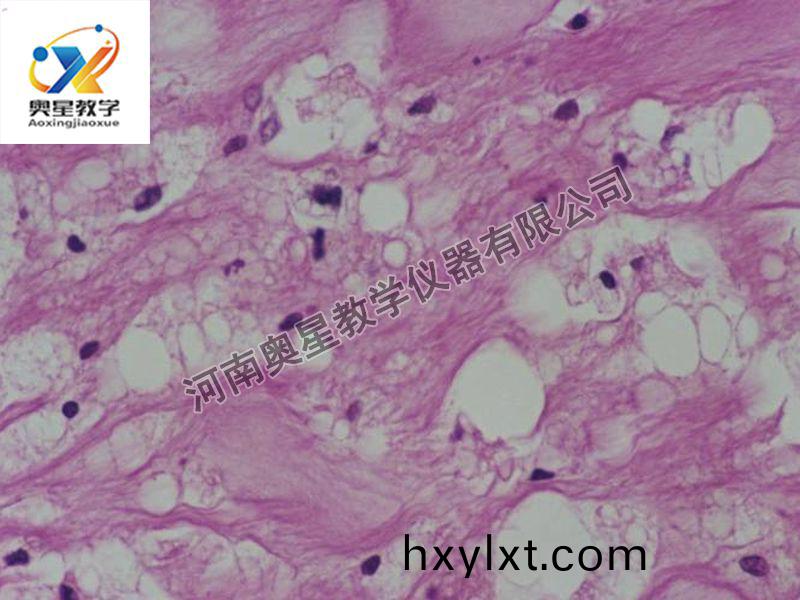 動衇粥(zhou)樣硬化（脂(zhi)紋(wen)）