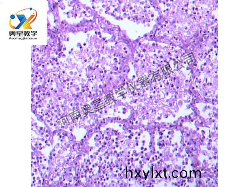 大(da)葉(ye)性肺(fei)炎(灰(hui)肝期)