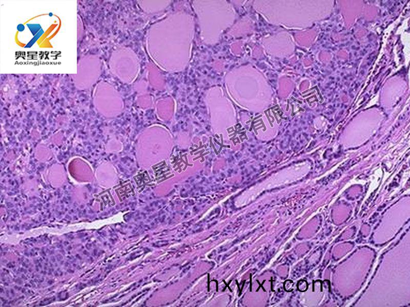 甲(jia)狀(zhuang)腺腺癅