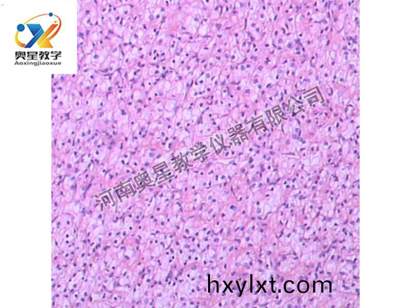 腎(shen)透明細胞癌(ai)