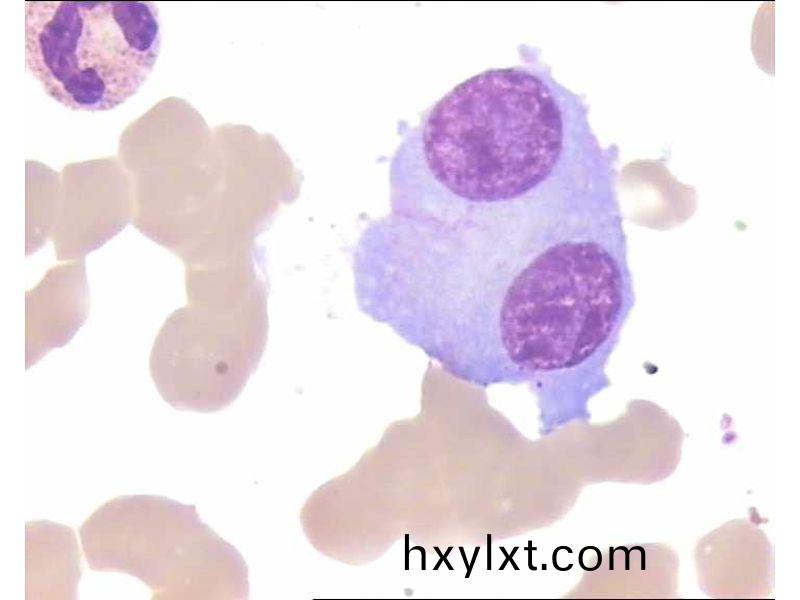 多髮(fa)性(xing)骨(gu)髓癅